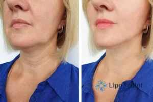 Double chin before and after Hi-Fu treatment 4 Book your double chin treatment Canvey Island today! We are here to help!