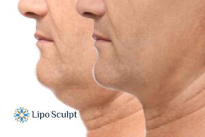 Double chin before and after Hi-Fu treatment 2 Double chin treatment Canvey Island from Lipo Sculpt - feel more confident today!