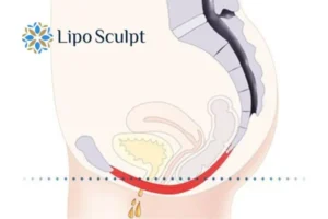 Pelvic Floor Chair Therapy 1 Pelvic Floor Chair Therapy Canvey Island to treat incontinence.