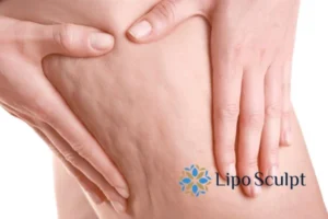 CoolSculpting for Legs: The Innovative Approach to Redefining Your Legs 5 Start your journey today book your coolsculpting treatment Canvey Island online today!
