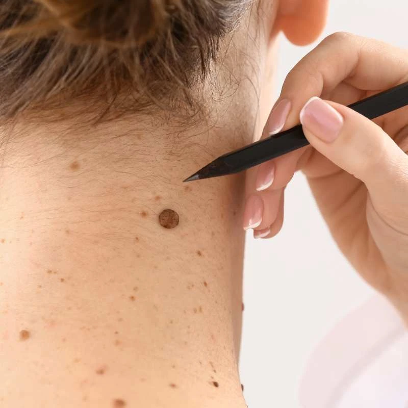 See our lesion removal prices Canvey Island - call today for a free quote